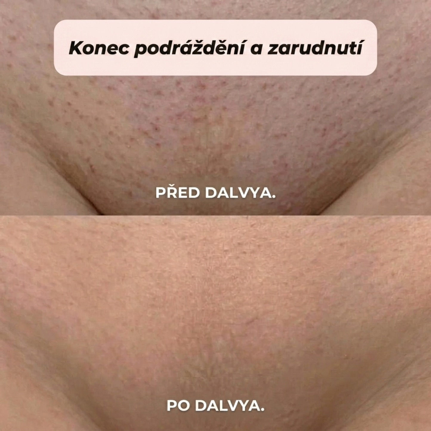 DALVYA™ – HOLICÍ STROJEK 2 V 1 NA BIKINI ZÓNU A TĚLO