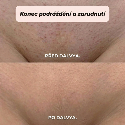DALVYA™ – HOLICÍ STROJEK 2 V 1 NA BIKINI ZÓNU A TĚLO
