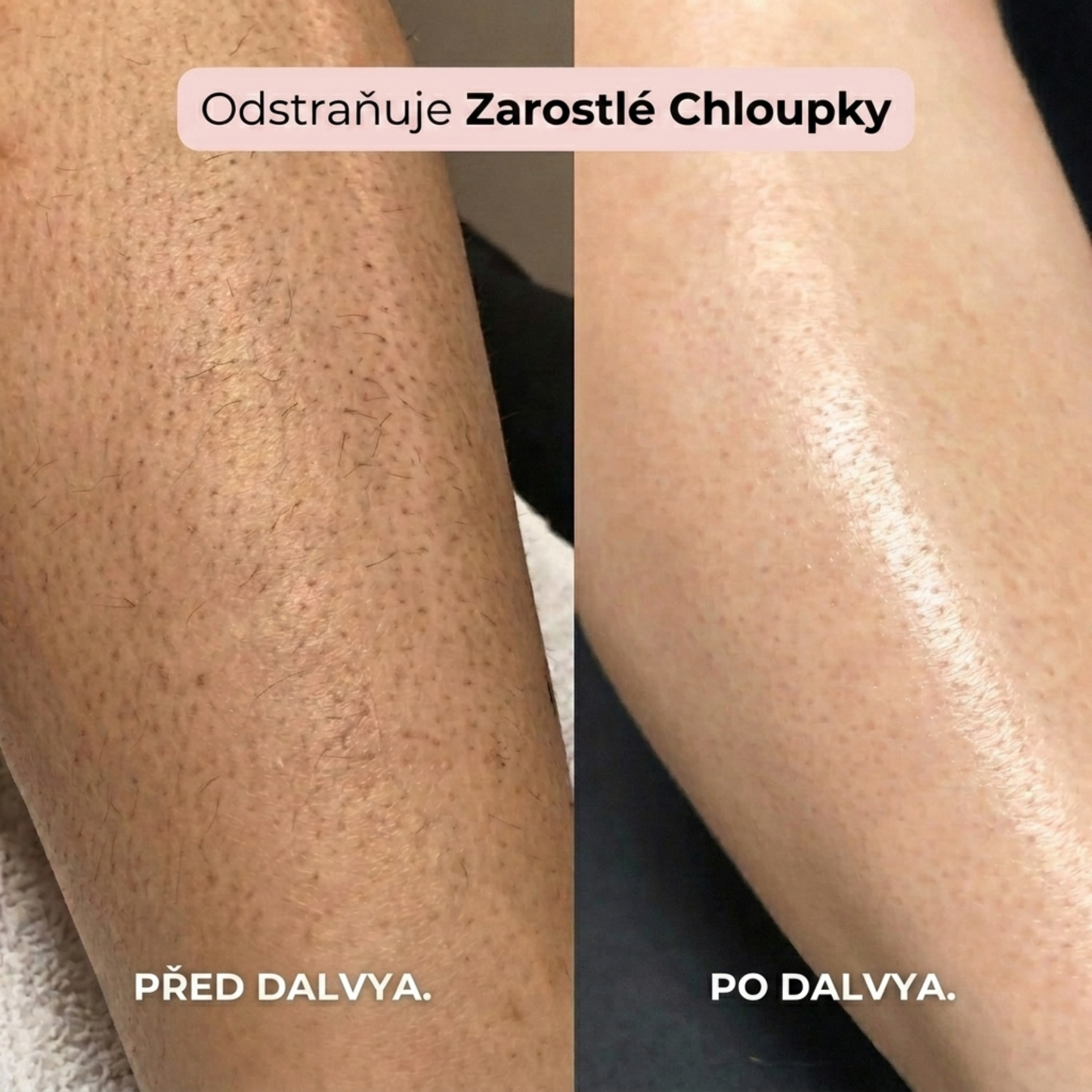 DALVYA™ – HOLICÍ STROJEK 2 V 1 NA BIKINI ZÓNU A TĚLO